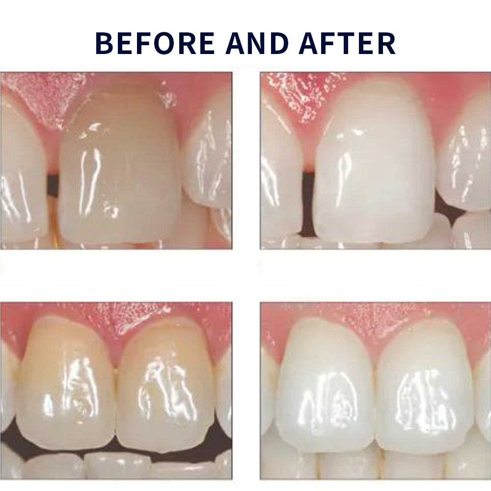 Opalescence Whitening 20% PF 2 - Teeth Whitening Gels บทวิจารณ์และราคา