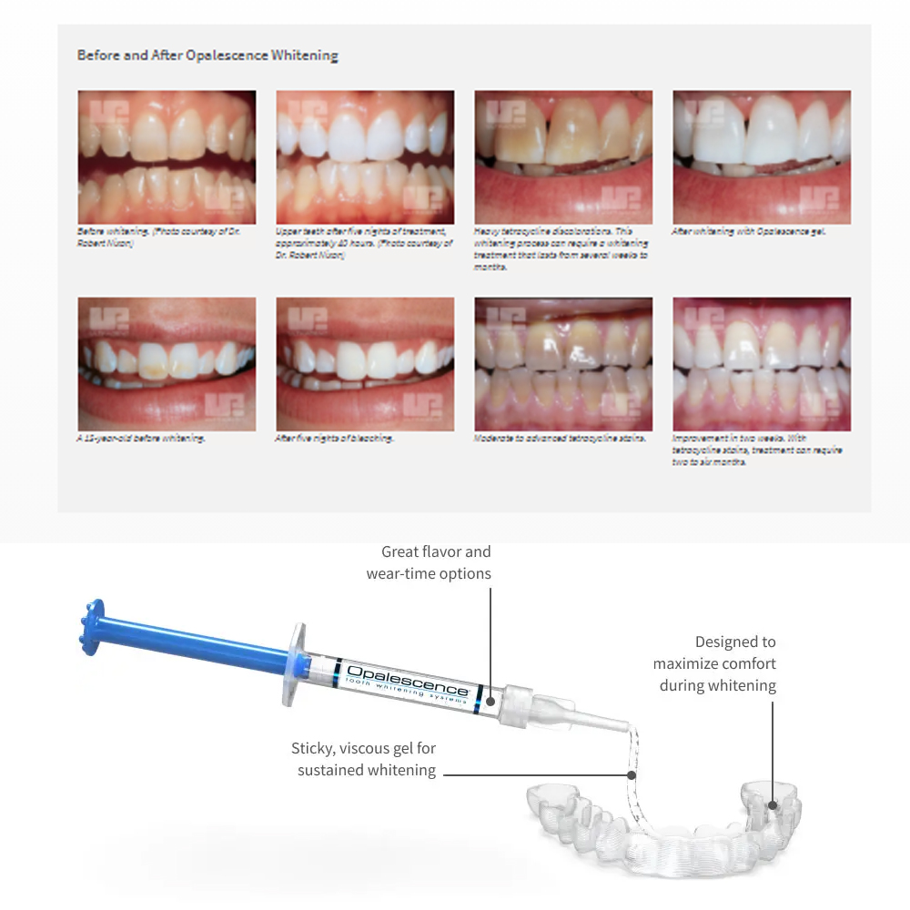 Opalescence Whitening 20% PF 2 - Teeth Whitening Gels บทวิจารณ์และราคา