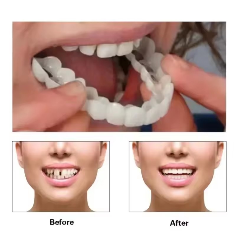 Teeth Veneers Whitening Dentur - Teeth Whitening Kit บทวิจารณ์และราคา