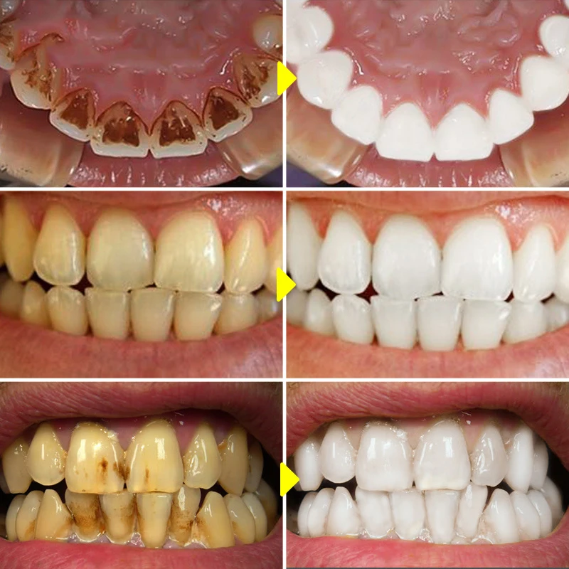 V34 Teeth Whitening Mousse Too - Teeth Whitening Xylitol บทวิจารณ์และราคา