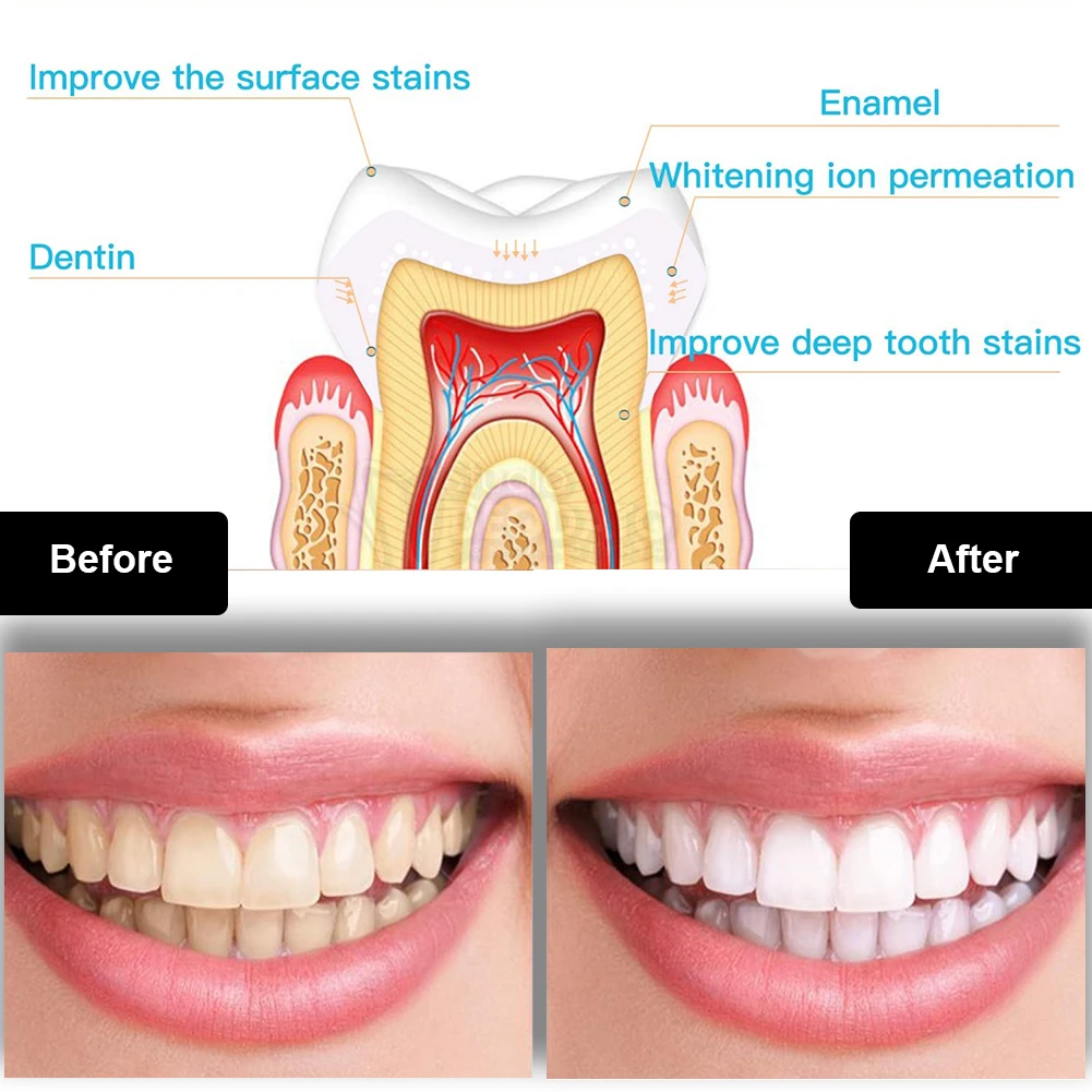 Dental Teeth Whitening Kit Min - Teeth Whitening Gels บทวิจารณ์และราคา